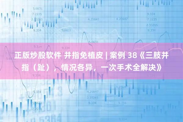正版炒股软件 并指免植皮 | 案例 38《三肢并指（趾），情况各异，一次手术全解决》